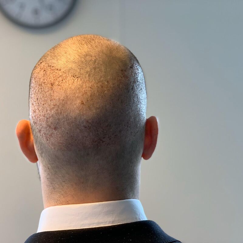 Joren haartransplantatie turkije