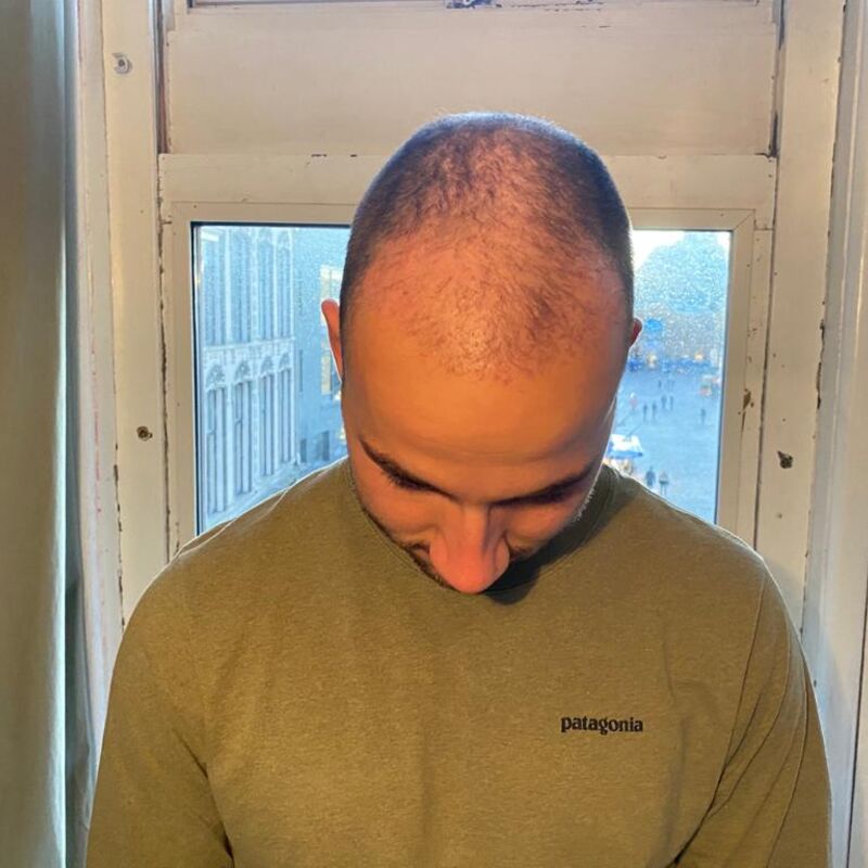 Jelmer, 100% vertrouwen in haartransplantatie resultaat