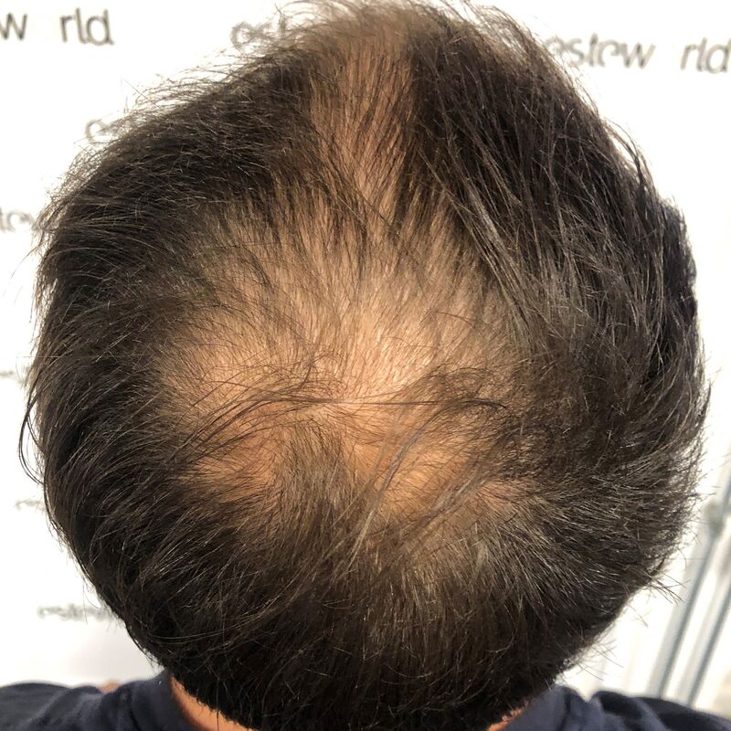 Jelmer, 100% vertrouwen in haartransplantatie resultaat