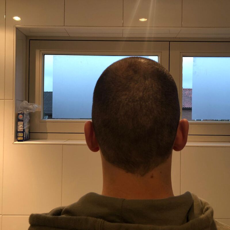 Jelmer, 100% vertrouwen in haartransplantatie resultaat