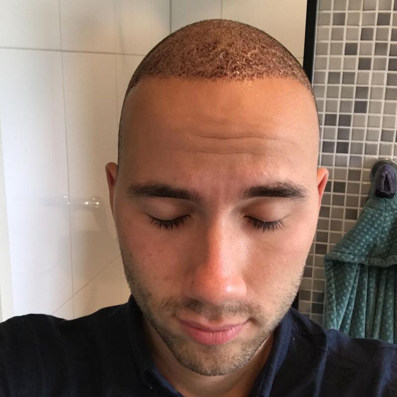 Jelmer, 100% vertrouwen in haartransplantatie resultaat