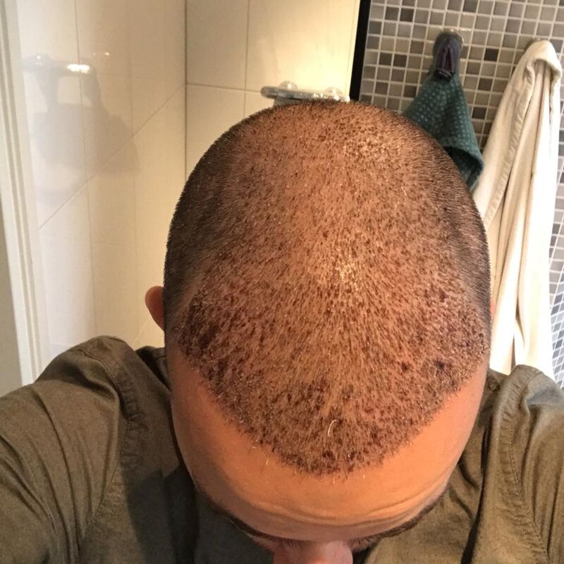 Jelmer, 100% vertrouwen in haartransplantatie resultaat