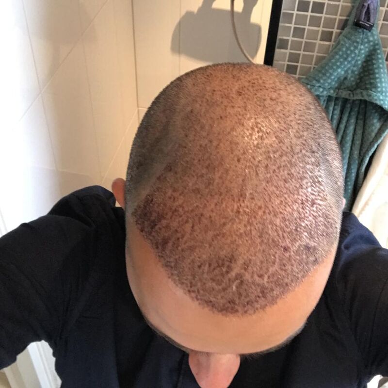 Jelmer, 100% vertrouwen in haartransplantatie resultaat