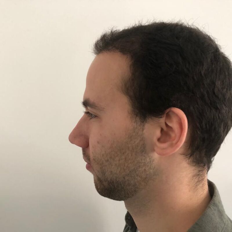 Jelmer, 100% vertrouwen in haartransplantatie resultaat