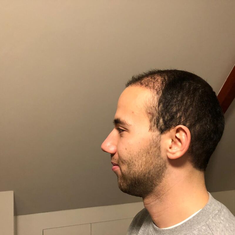 Jelmer, 100% vertrouwen in haartransplantatie resultaat