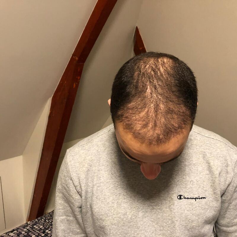 Jelmer, 100% vertrouwen in haartransplantatie resultaat