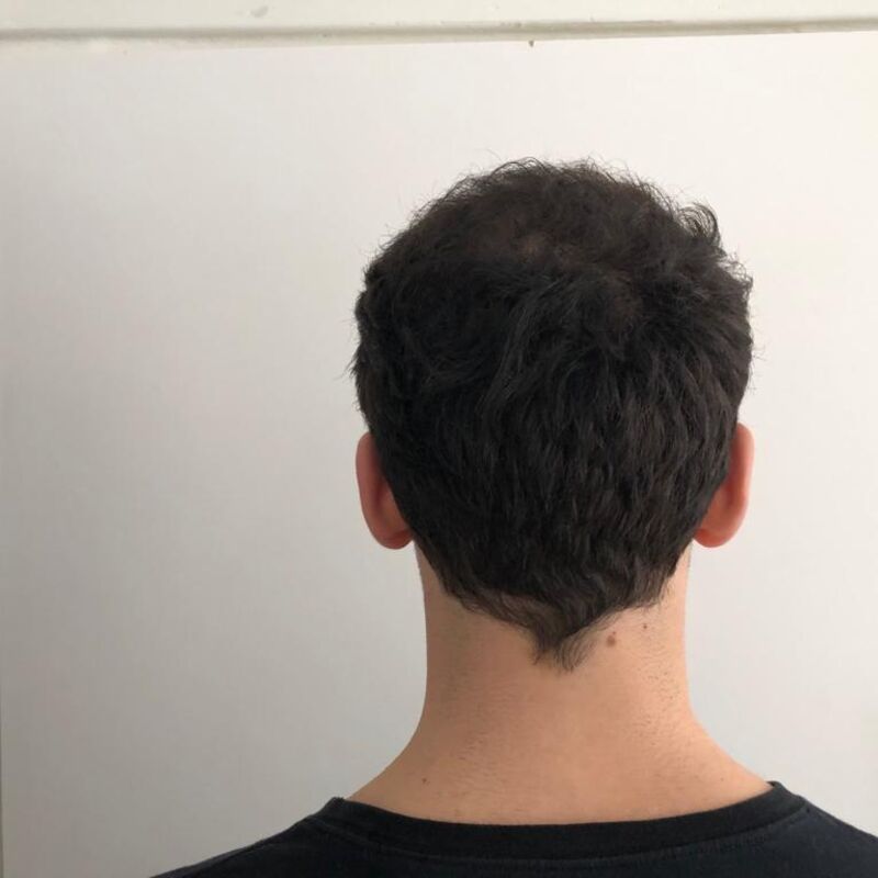 Jelmer, 100% vertrouwen in haartransplantatie resultaat