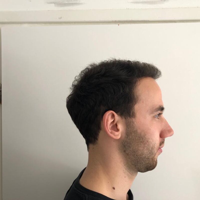 Jelmer, 100% vertrouwen in haartransplantatie resultaat