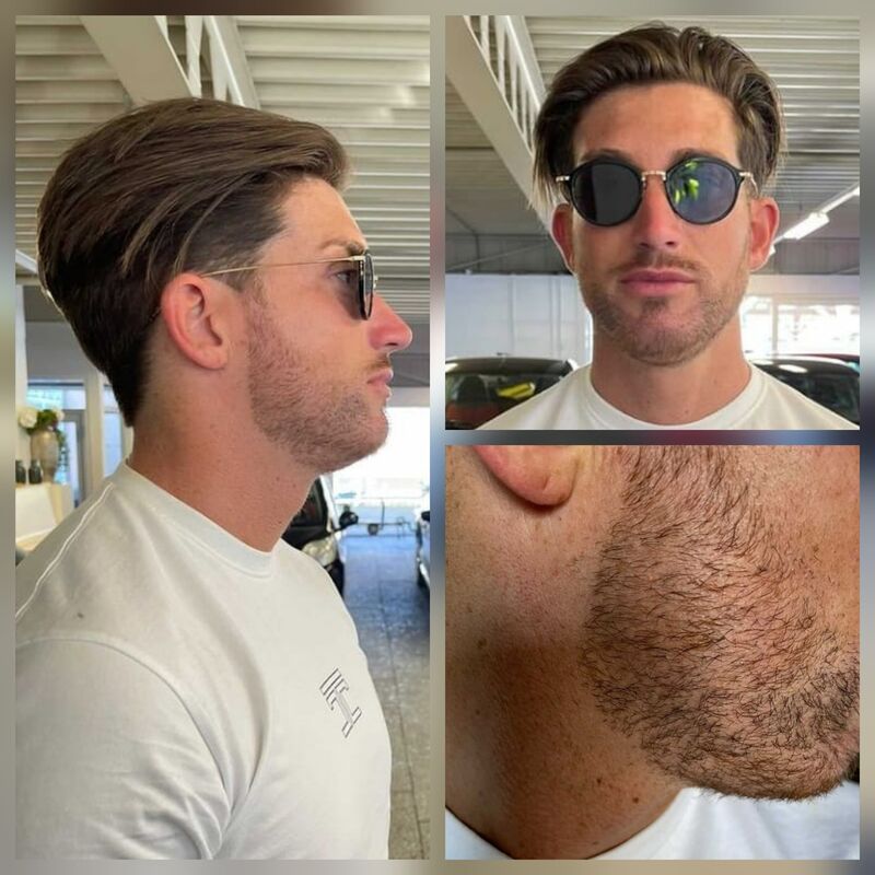 @niekmarijnissen baardtransplantatie bij Esteworld