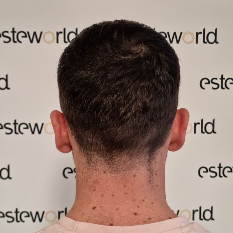 Een haartransplantatie spookte al zo lang door mijn hoofd