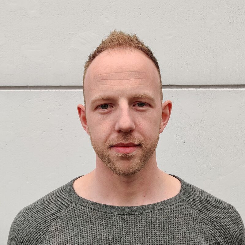 Jordy eindresultaat haartransplantatie