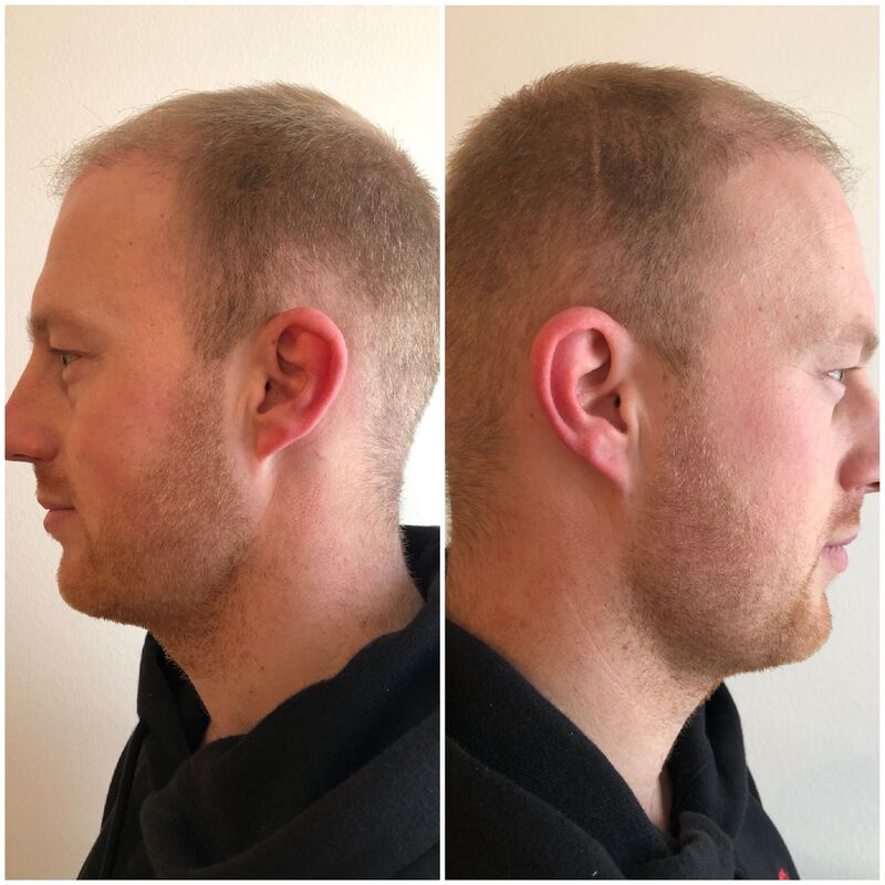 Oprecht heel tevreden haartransplantatie resultaat