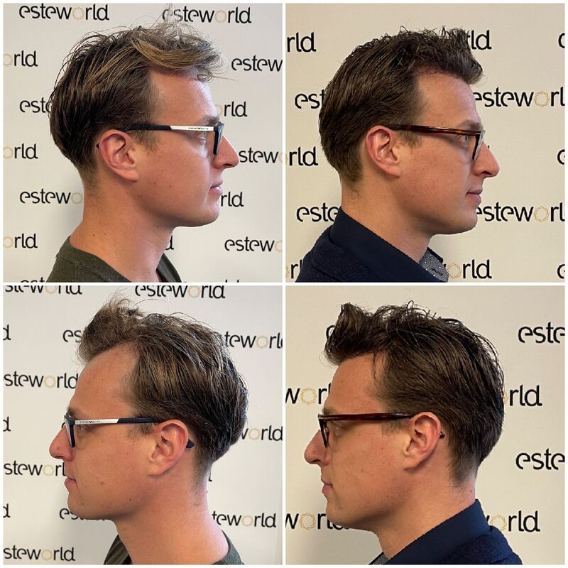 Kaal worden accepteren of actie. Voor mij Actie!
