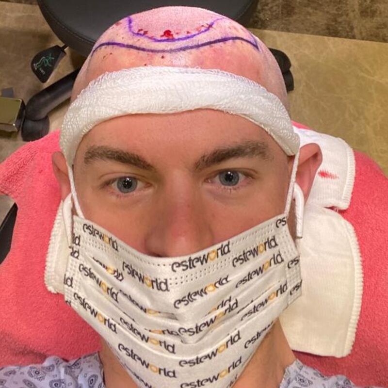 Marco van Dam straalt na zijn haartransplantatie