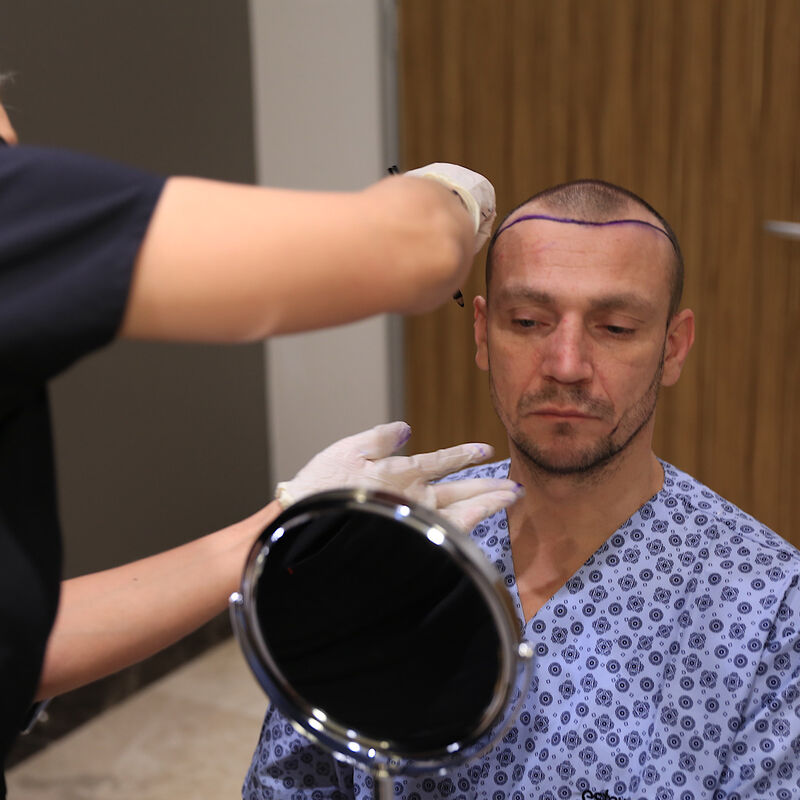 Baard/haartransplantatie voor Joris