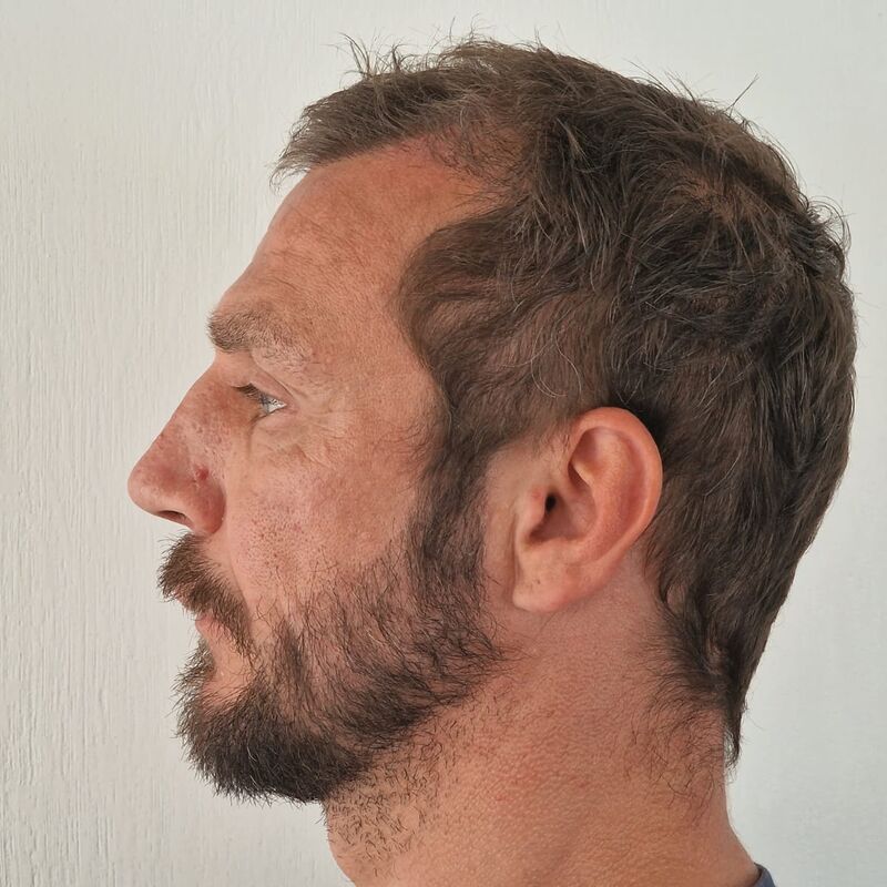 Baard/haartransplantatie voor Joris