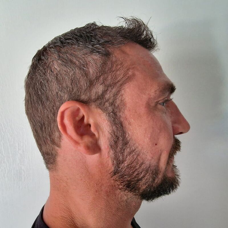 Baard/haartransplantatie voor Joris