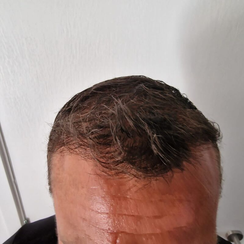 Baard/haartransplantatie voor Joris