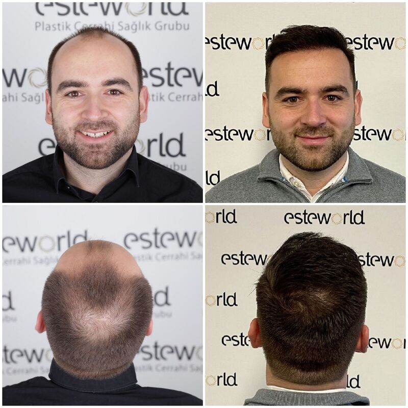 Mijn haartransplantatie resultaat is bekend!