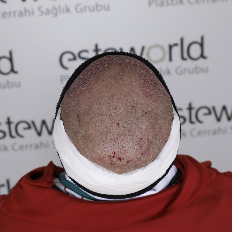 Haartransplantatie met kroeshaar, niemand die het ziet