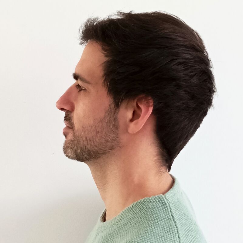 Na jarenlang onderzoek toch een haartransplantatie in Turkije
