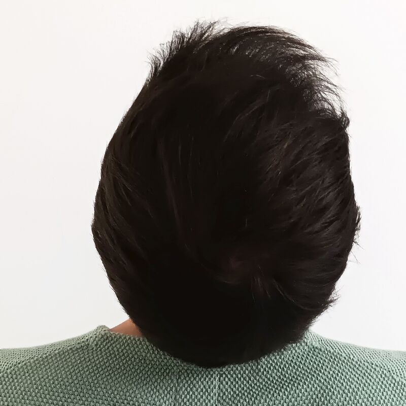 Na jarenlang onderzoek toch een haartransplantatie in Turkije