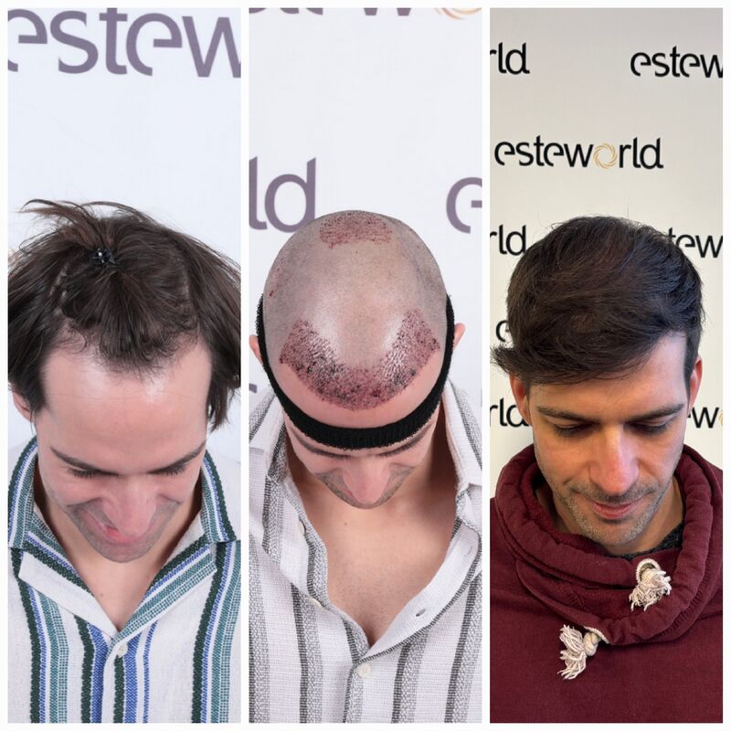 Na jarenlang onderzoek toch een haartransplantatie in Turkije