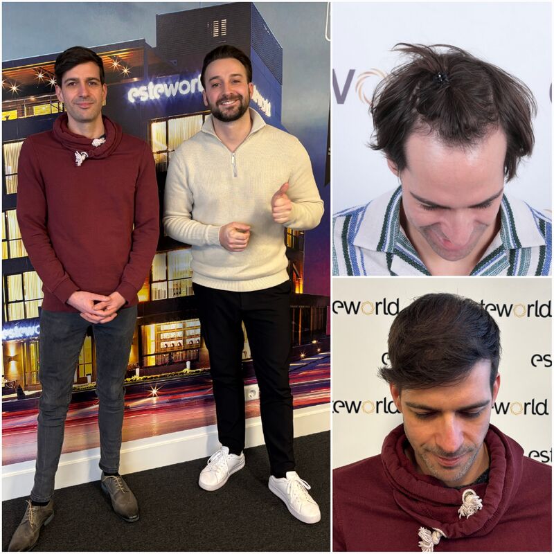 Na jarenlang onderzoek toch een haartransplantatie in Turkije