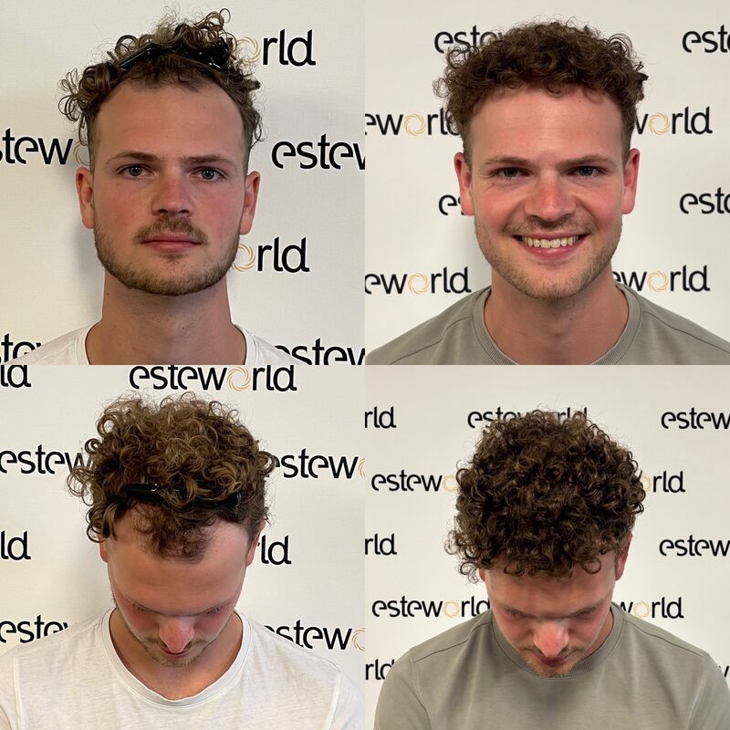 Door research (haarweb, etc.) voor haartransplantatie in Turkije gekozen.