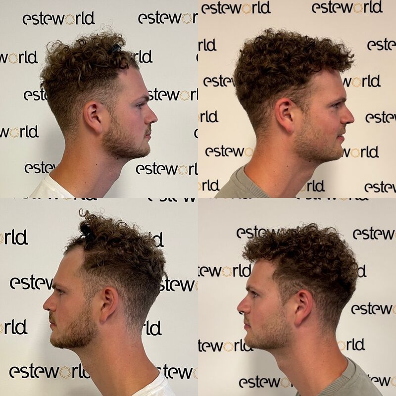 Door research (haarweb, etc.) voor haartransplantatie in Turkije gekozen.