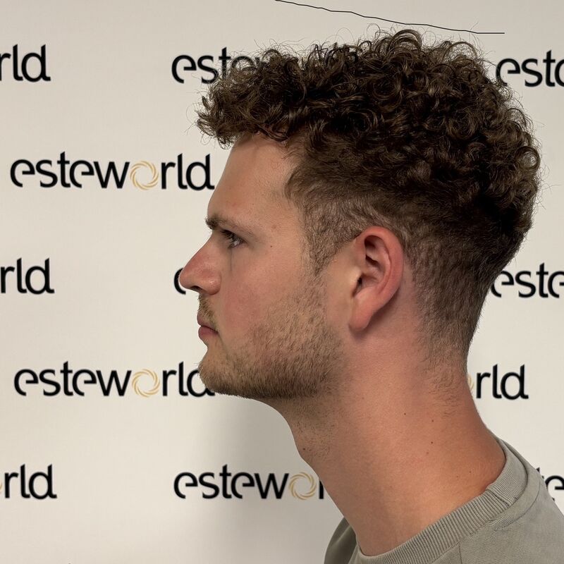 Door research (haarweb, etc.) voor haartransplantatie in Turkije gekozen.