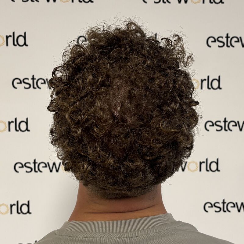 Door research (haarweb, etc.) voor haartransplantatie in Turkije gekozen.