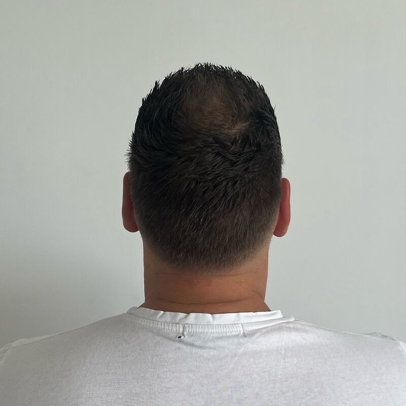 Joeri, zoals veel mannen begon ik kaal te worden
