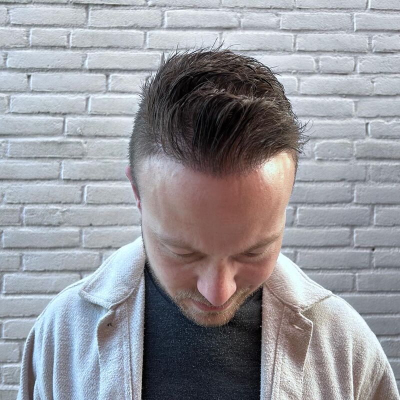 Als tiener al besloten, bij kaal een haartransplantatie