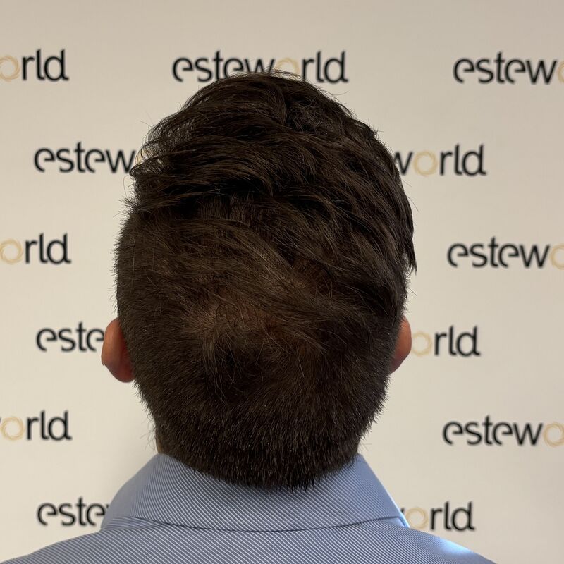 Als tiener al besloten, bij kaal een haartransplantatie