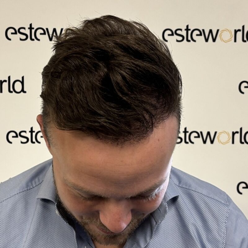 Als tiener al besloten, bij kaal een haartransplantatie