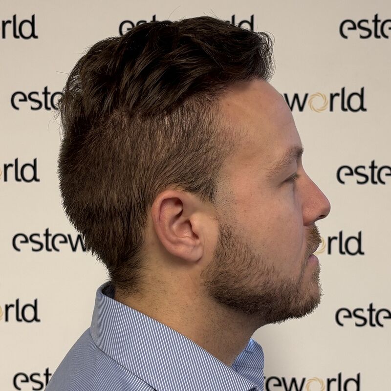 Als tiener al besloten, bij kaal een haartransplantatie