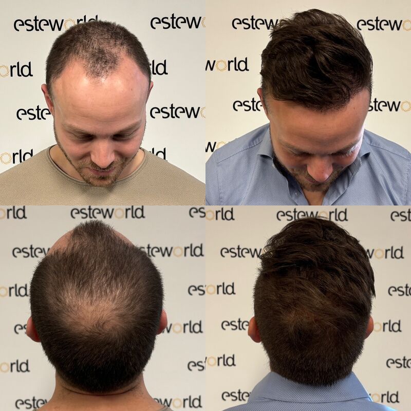 Als tiener al besloten, bij kaal een haartransplantatie