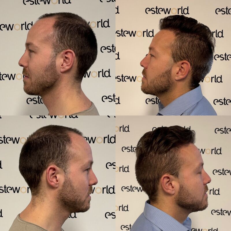 Als tiener al besloten, bij kaal een haartransplantatie