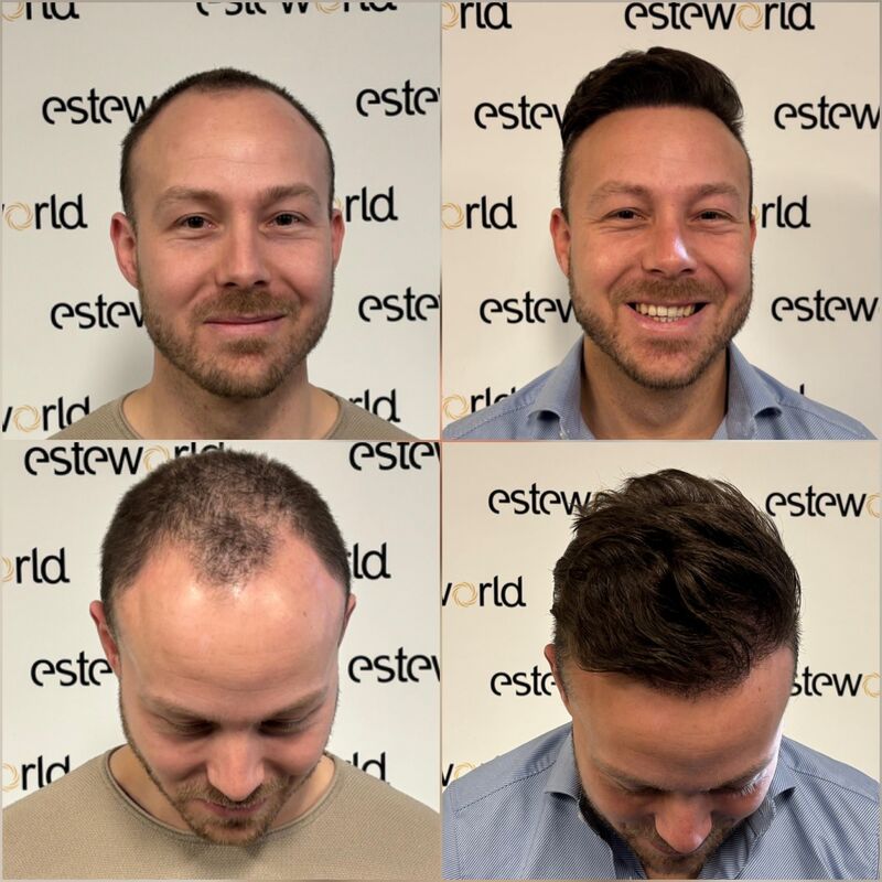 Als tiener al besloten, bij kaal een haartransplantatie