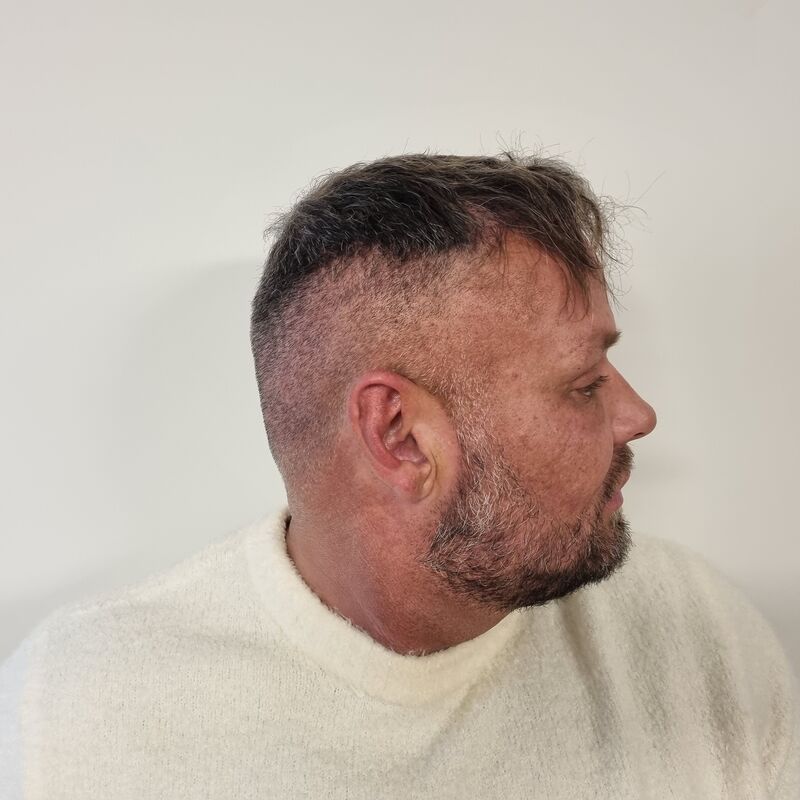 Micheal van der Plas baard en herstel haartransplantatie
