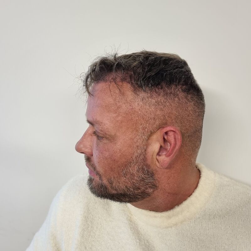 Micheal van der Plas baard en herstel haartransplantatie