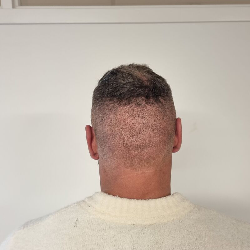 Micheal van der Plas baard en herstel haartransplantatie