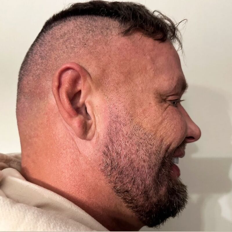 Micheal van der Plas baard en herstel haartransplantatie