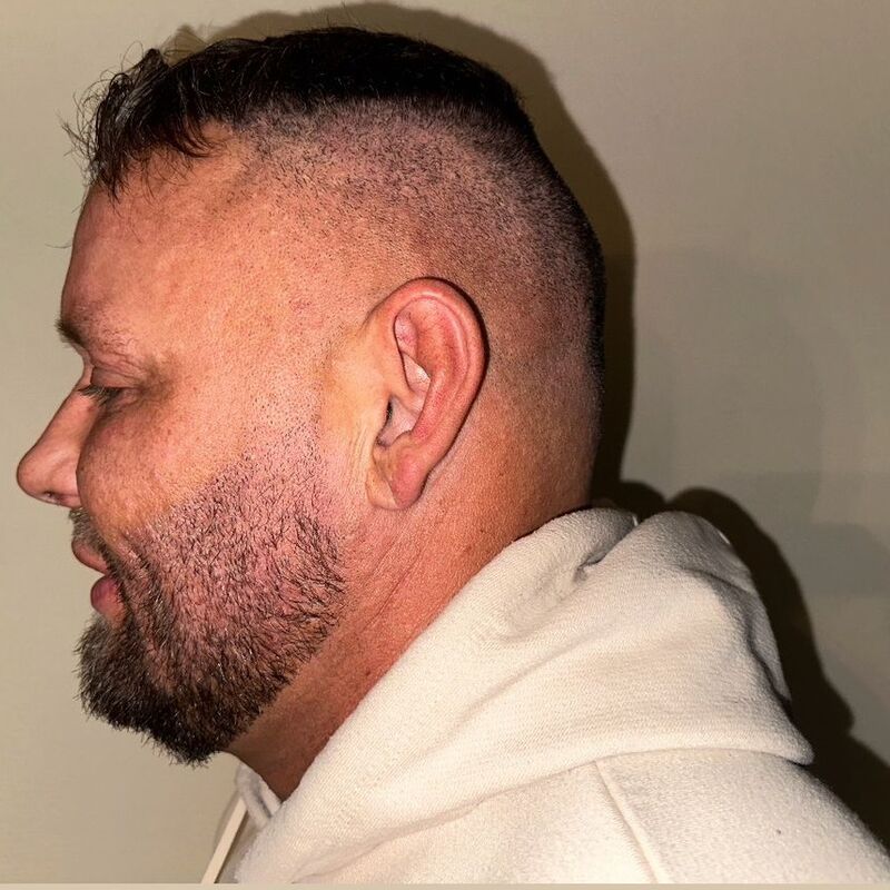 Micheal van der Plas baard en herstel haartransplantatie