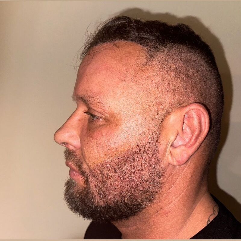Micheal van der Plas baard en herstel haartransplantatie