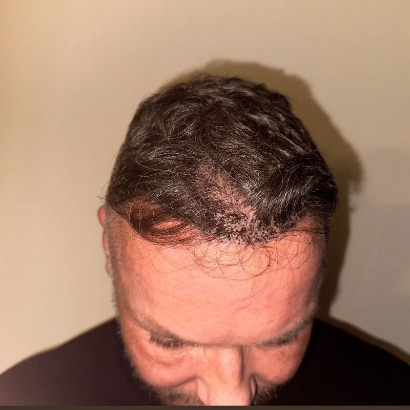 Micheal van der Plas baard en herstel haartransplantatie