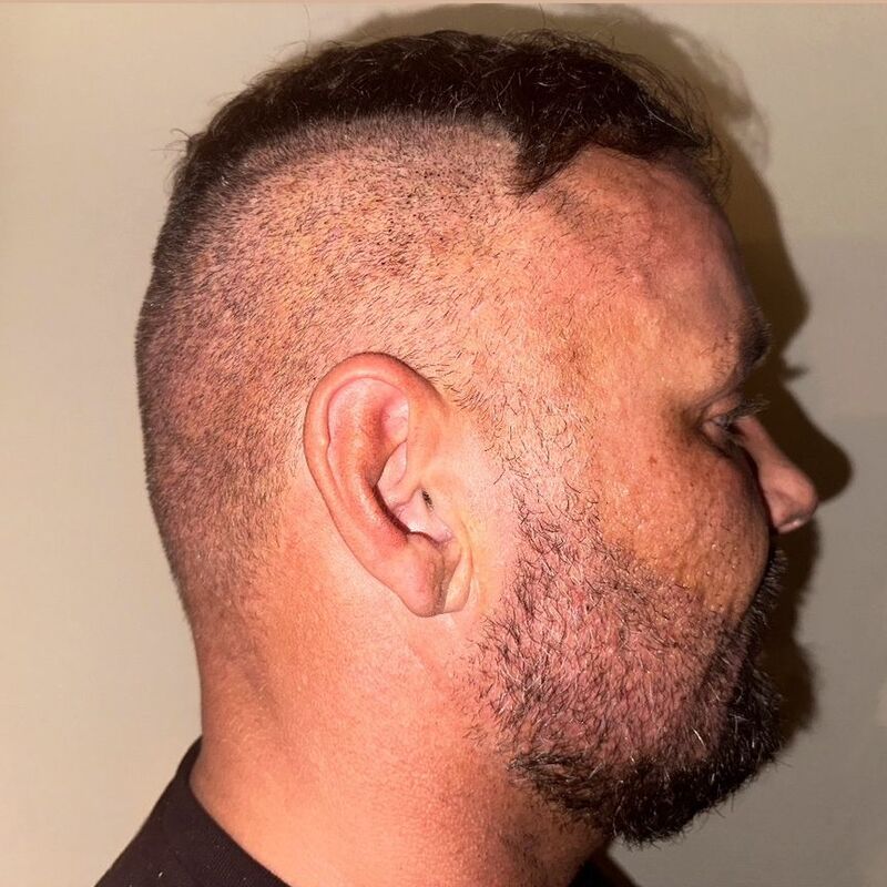 Micheal van der Plas baard en herstel haartransplantatie