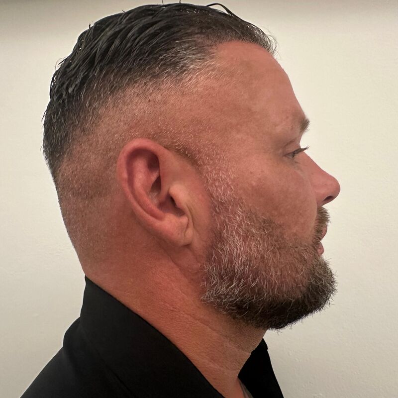 Micheal van der Plas baard en herstel haartransplantatie