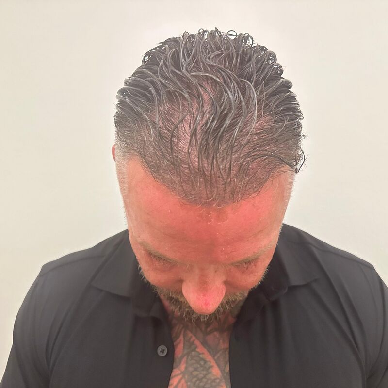 Micheal van der Plas baard en herstel haartransplantatie